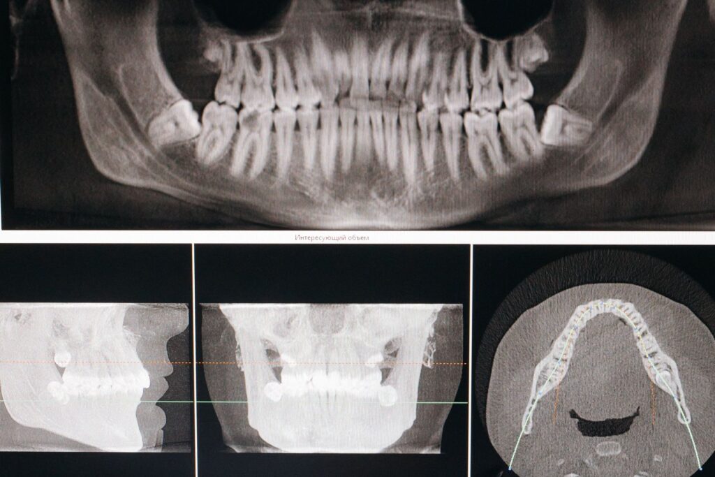 Dentist reviewing a panoramic dental X-ray on a computer monitor