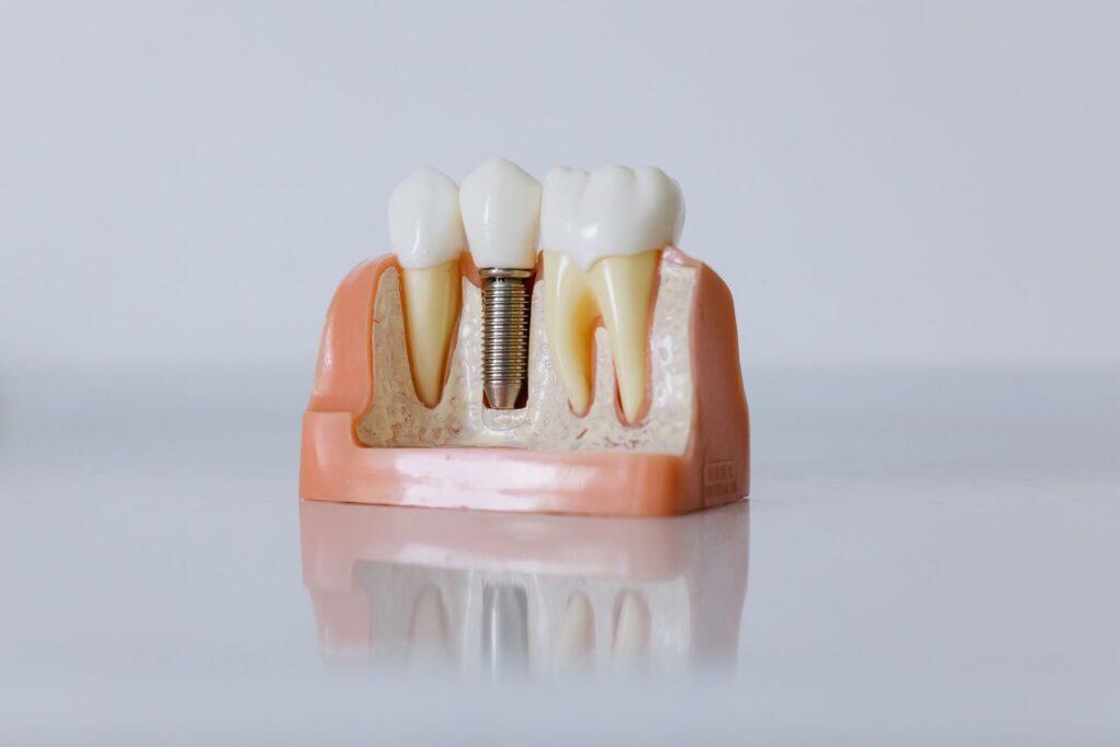 Cross-section model of a dental implant beside natural teeth
