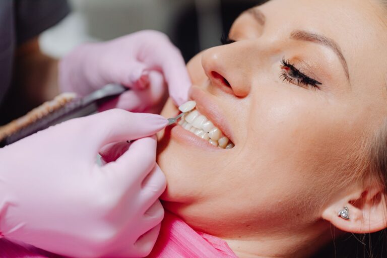 Dental Veneers: Types, Procedure, Lifespan, and What to Know Before You Decide